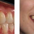 Dental implants in Midtown, NYC