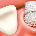 Bone Grafting