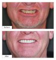 Dental Implants Brooklyn – Implant Dentistry