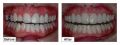 Porcelain Dental Veneers Brooklyn, NY