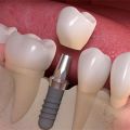 Dental Implants Yonkers, NY – Tooth Implants