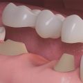 Dental Bridge in 505 Dental Associates