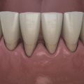 Periodontics (latest dental lasers) - Top Rated Periodontist