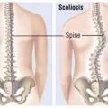 Scoliosis Diagnosis & Treatment – Back Pain Doctors Brooklyn NYC