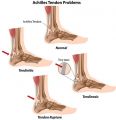 NYC Ankle Injuries Treatment Doctor, Specialist · Sports Pain Management Clinic