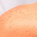 Age Spots Removal · Manhattan Dermatologist · Cosmetic Laser Dermatology NYC