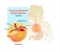 Best GERD Specialists in Upper East Side, NYC