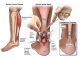 Achilles Tendon Repair Surgery in NYC