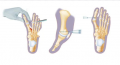 Minimally Invasive Foot Surgery