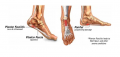 Plantar Fasciitis Surgery in NYC