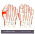 Plantar Fasciitis Surgery in NYC