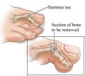 NYC Hammer Toe Surgery · Best Foot Surgeons · Podiatrist Midtown Manhattan NY