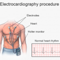 Electrocardiogram (EKG or ECG)