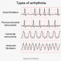 Heart Arrhythmia Specialist