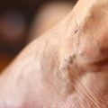 SCLEROTHERAPY FOR SPIDER VEINS