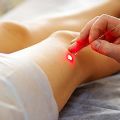 LASER THERAPY FOR SPIDER VEINS