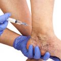 SCLEROTHERAPY FOR VARICOSE VEINS