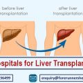 The Legends of Liver Transplants: India’s Most Renowned Surgeons