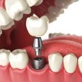Why are immediate dental implants necessary & when may you possibly need them?