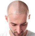 How about getting scalp micropigmentation to get rid of baldheadedness?