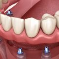 Acknowledge yourself about what benefits do dental implants bring with itself