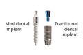 Mini Dental Implants in Brooklyn | Mini Teeth Implants