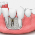 Bone Grafting for Dental Implants in Brooklyn, NY.