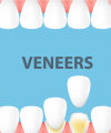 Porcelain Dental Veneers