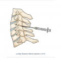 Lumbar Epidural Steroid Injection in NYC