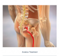 Sciatica Treatment Doctors Specialists in Manhattan, NYC