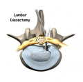 Lumbar Discectomy Surgery in NYC