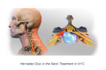 Herniated Disc in the Neck Treatment in NYC