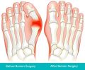 Bunion Surgery Specialists