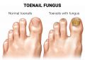 Toenail Fungus