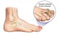 Hammer Toe Surgery