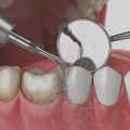Preventative care (cleanings)