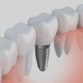 Dental Implants in Stamford, CT
