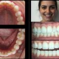 Invisalign in Stamford, CT – Invisalign Teeth Straightening Specialist
