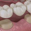 Dental Bridges in Stamford, CT