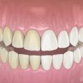 Zoom Teeth Whitening in Stamford, CT