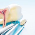What Exactly Is A Root Canal?