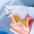 Does It Hurt To Get Dental Implants?