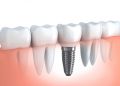 Dental Implants in Midtown NYC