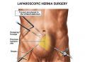 Laparoscopic Hernia Surgery