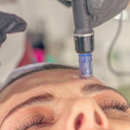Is Microneedling Right For You?