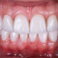 Cosmetic Dentistry in Astoria, Queens