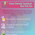 Dental Sealants for Kids and Teens