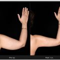 Upper Arm Liposuction – For Toned, Proportionate Arms