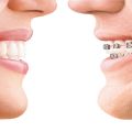 The Latest Advances in Teeth Straightening at Amma Naana Dental Clinic