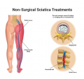 Sciatica Treatment Specialists in NYC